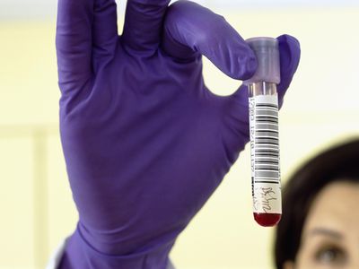 Close up of pathologist in rubber gloves holding blood sample