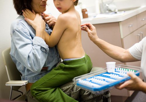 child getting a skin prick test