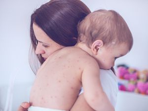 妈妈抱着患水痘的婴儿