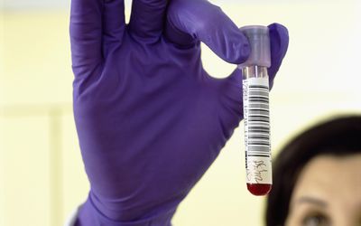 病理学家戴着橡胶手套拿着血样的特写
