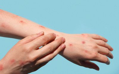 monkeypox