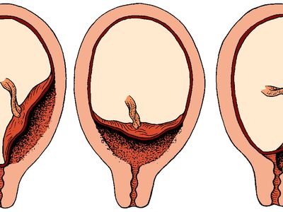 There are three types of placenta previa.