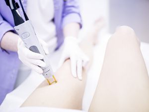 激光脱毛治疗