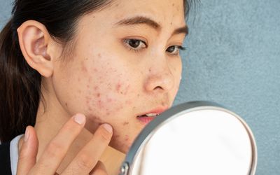 女人在镜子里看着脸上的粉刺