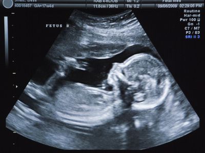 Ultrasound image of a fetus