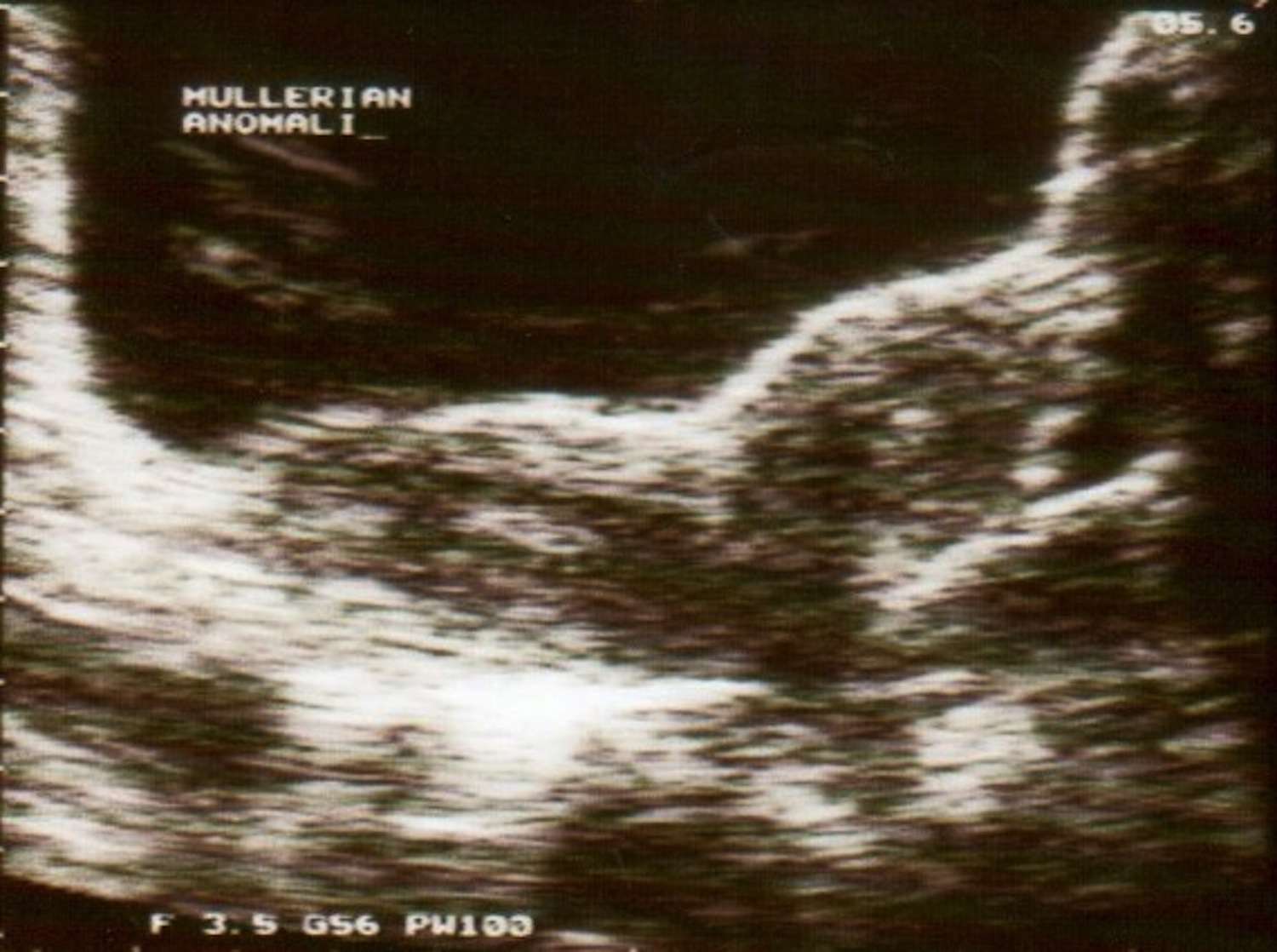Ultrasound image showing duplication of uterus corpus