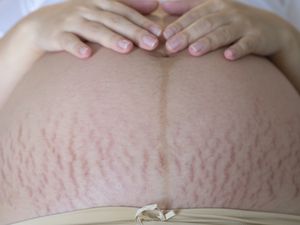 怀孕的肚子上有妊娠纹