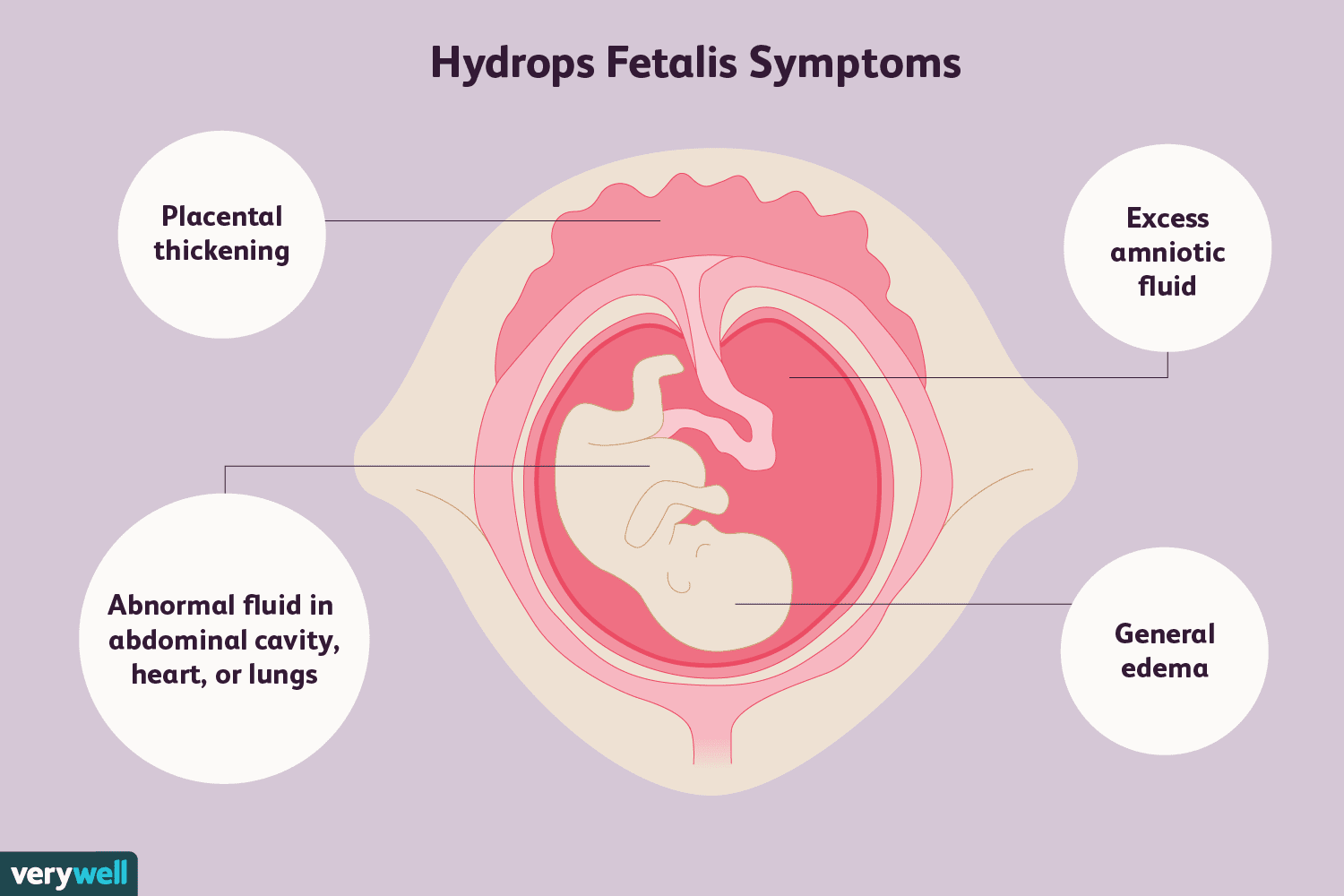 Illustration of hydrops fetalis symptoms